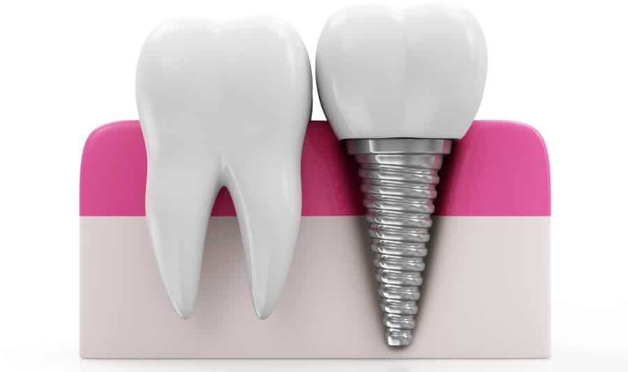 آیا روکش ایمپلنت درد دارد؟