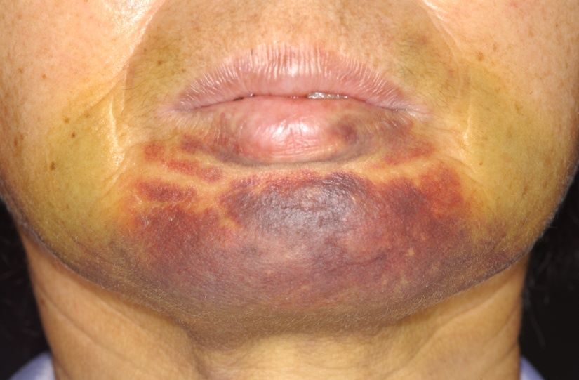 کبودی صورت بعد از ایمپلنت