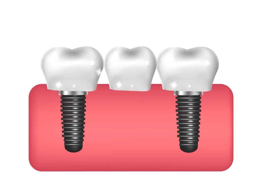 روکش ایمپلنت دندان جلو