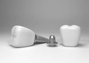 روکش ایمپلنت