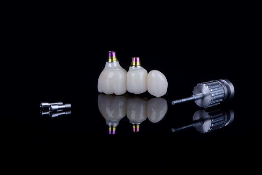 هزینه ایمپلنت دندان به شکل زیگوماتیک