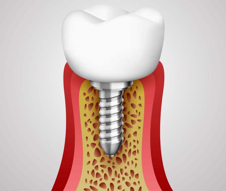 عوارض ایمپلنت زیگوماتیک
