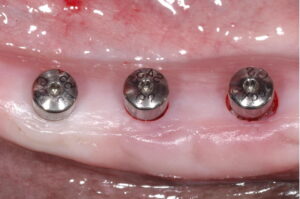 ایمپلنت به روش پانچی